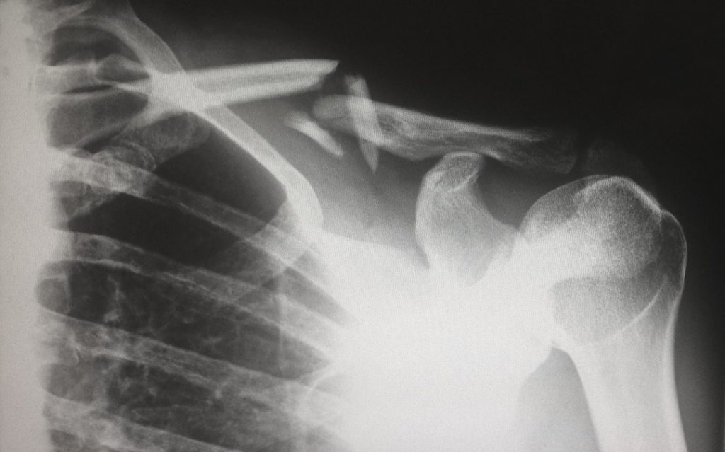 An xray image of a broken collar bone. Low-carb diets cause bone loss and can potentially result in osteoporosis